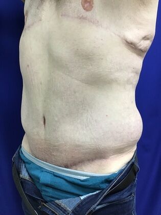 Male Body Contouring: Case 5 (1711736) - After