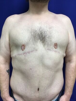 Male Body Contouring: Case 5 (1711736) - After, gland and major skin removal, nipple graft reconstruction