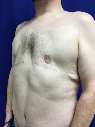 Male Body Contouring: Case 5 (1711736) - After