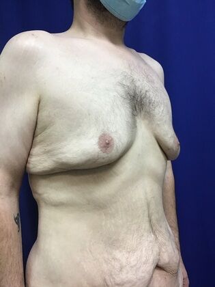 Male Body Contouring: Case 5 (1711736) - Before