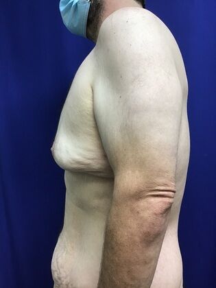 Male Body Contouring: Case 5 (1711736) - Before