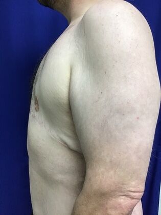 Male Body Contouring: Case 5 (1711736) - After