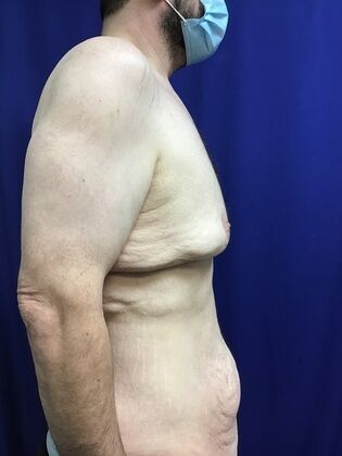 Male Body Contouring: Case 5 (1711736) - Before