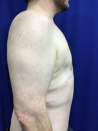 Male Body Contouring: Case 5 (1711736) - After