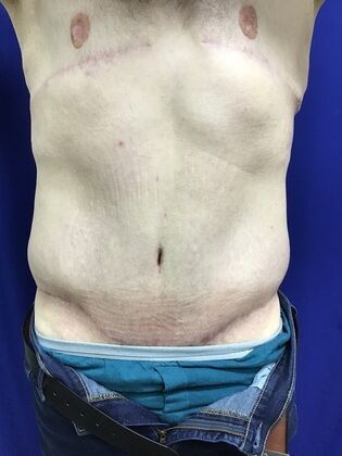 Male Body Contouring Case 5 (1711736) - After