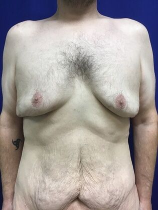 Male Breast / Gynecomastia Case 8 (1711736) - Before