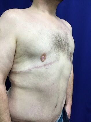 Male Breast / Gynecomastia: Case 8 (1711736) - After