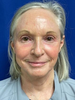 Facial Facelift / Necklift Case 25 (579389) - After