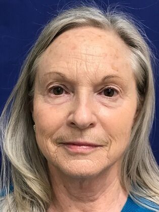 Facial Facelift / Necklift Case 25 (579389) - Before