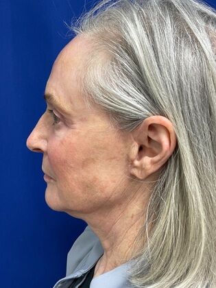 Facial Facelift / Necklift: Case 25 (579389) - After