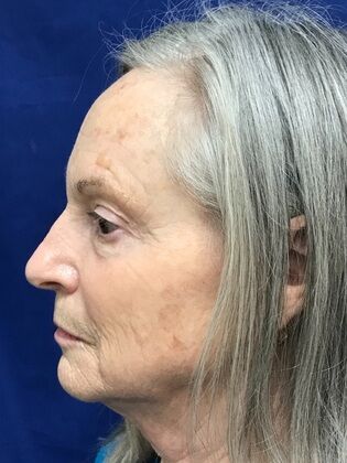 Facial Facelift / Necklift: Case 25 (579389) - Before