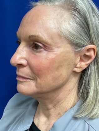 Facial Facelift / Necklift: Case 25 (579389) - Before