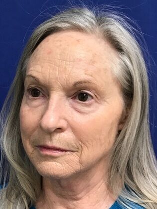 Facial Facelift / Necklift: Case 25 (579389) - After