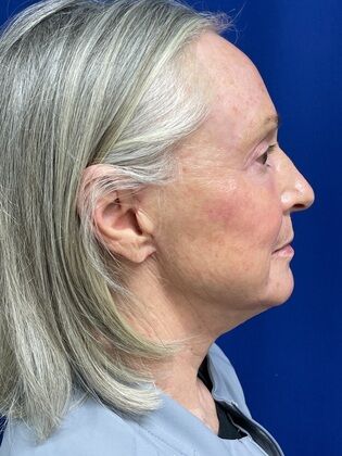 Facial Facelift / Necklift: Case 25 (579389) - After