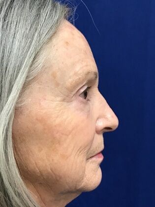 Facial Facelift / Necklift: Case 25 (579389) - Before