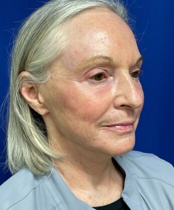 Facial Facelift / Necklift: Case 25 (579389) - After