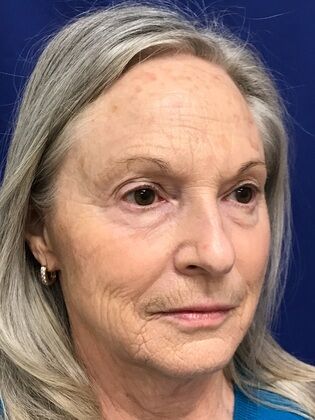 Facial Facelift / Necklift: Case 25 (579389) - Before