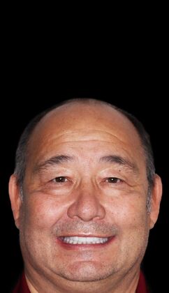 Full Mouth Restoration Kent- Smile MakeOver  - After