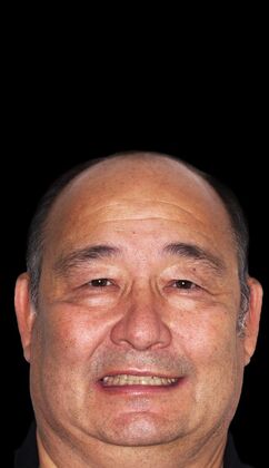 Full Mouth Restoration Kent- Smile MakeOver  - Before