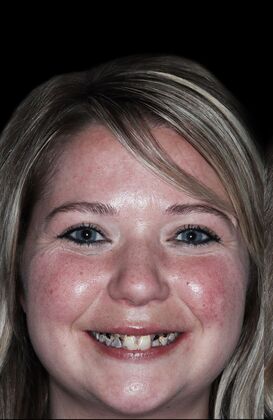 Full Mouth Restoration Molli - Smile Desing  - Before