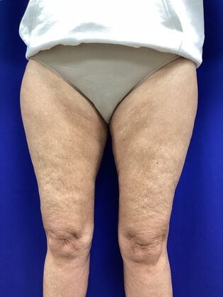 Thigh Reduction / Thighplasty: Case 1 (687012) - After, improved from groin to knees, including the front of the thighs