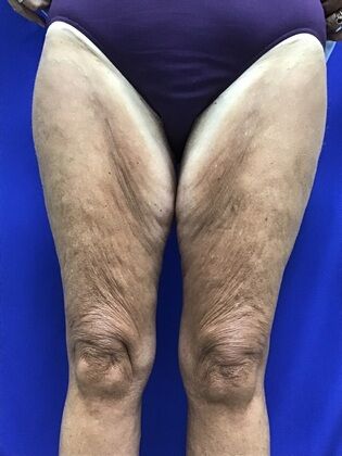 Thigh Reduction / Thighplasty: Case 1 (687012) - Before