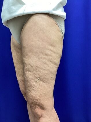 Thigh Reduction / Thighplasty: Case 1 (687012) - After