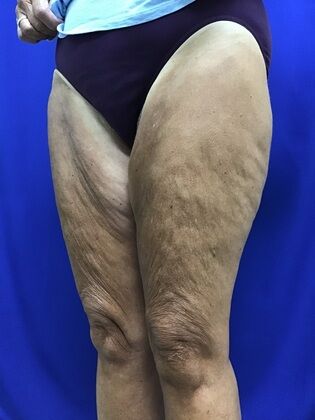 Thigh Reduction / Thighplasty: Case 1 (687012) - Before