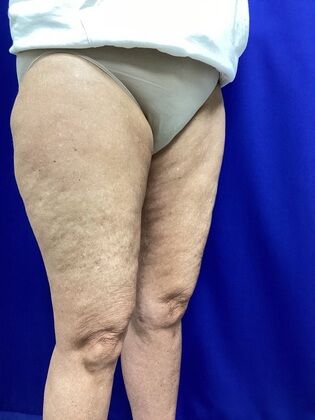 Thigh Reduction / Thighplasty: Case 1 (687012) - After