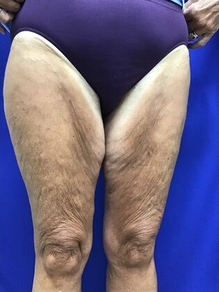 Thigh Reduction / Thighplasty: Case 1 (687012) - Before