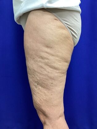 Thigh Reduction / Thighplasty: Case 1 (687012) - After