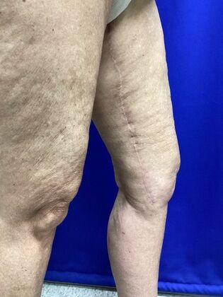 Thigh Reduction / Thighplasty: Case 1 (687012) - After, scar along inner thigh