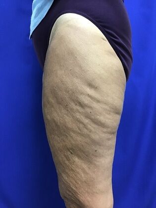 Thigh Reduction / Thighplasty: Case 1 (687012) - Before