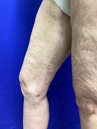 Thigh Reduction / Thighplasty: Case 1 (687012) - After, scar along inner thigh