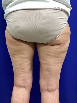 Thigh Reduction / Thighplasty: Case 1 (687012) - After