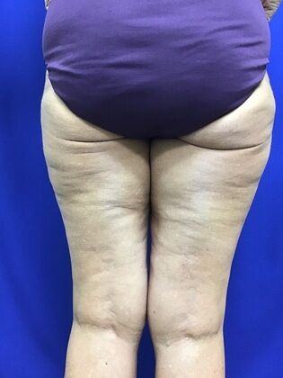 Thigh Reduction / Thighplasty: Case 1 (687012) - Before