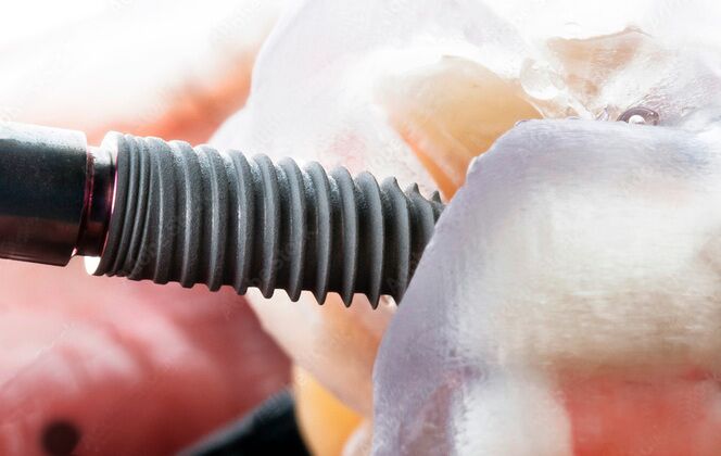 Dental Implants Cases