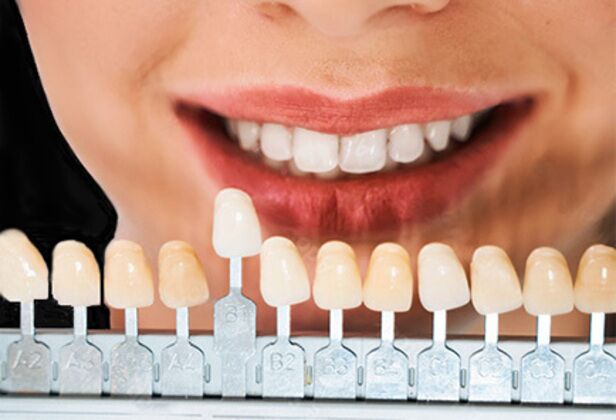 Porcelain Veneers Cases