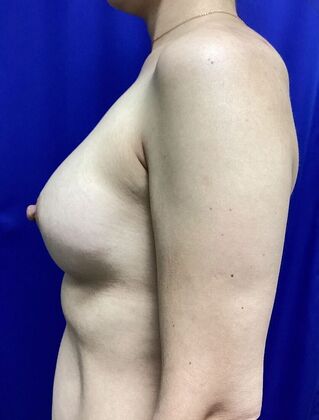 Breast Augmentation : Case 83 (3489732) - After