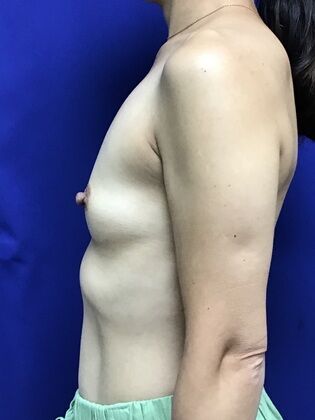 Breast Augmentation : Case 83 (3489732) - Before