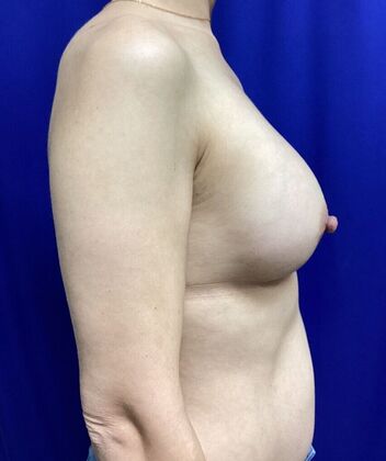 Breast Augmentation : Case 83 (3489732) - After