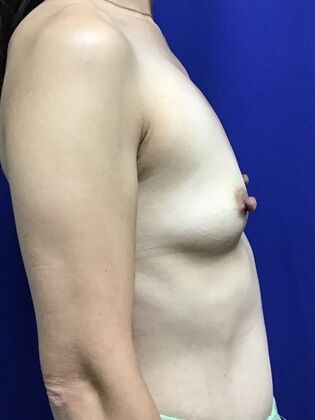 Breast Augmentation : Case 83 (3489732) - Before