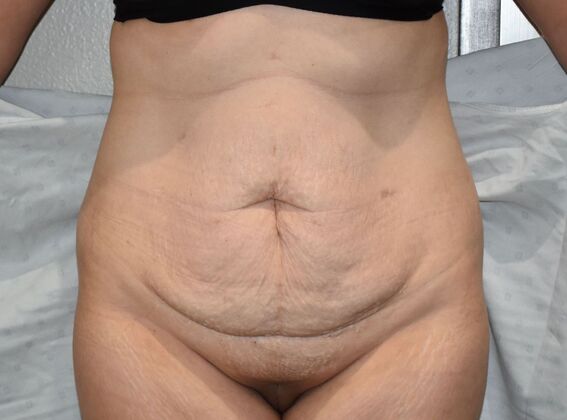 Tummy Tuck (Abdominoplasty): Case 383 - Before