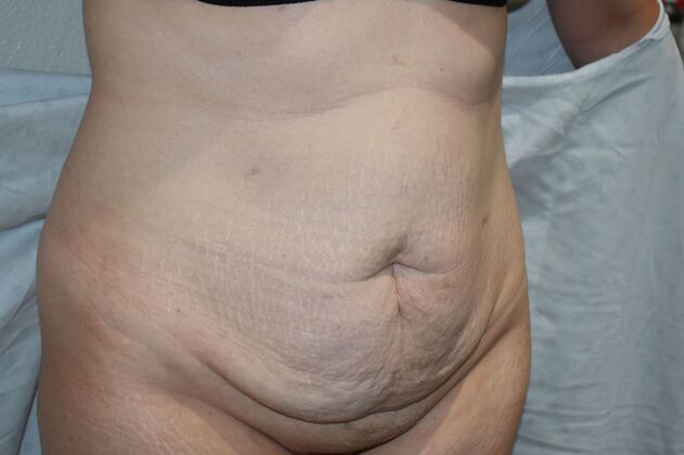 Tummy Tuck (Abdominoplasty): Case 383 - Before