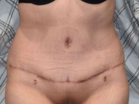 Tummy Tuck (Abdominoplasty): Case 383 - After