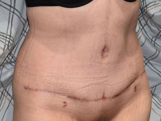 Tummy Tuck (Abdominoplasty): Case 383 - After