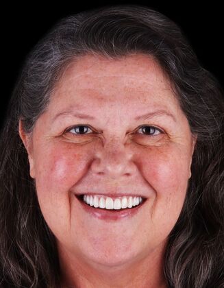 Full Mouth Restoration Jeane- E-max crowns - After