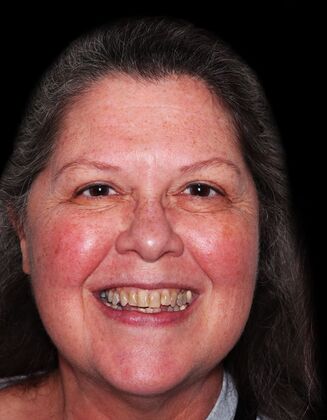 Full Mouth Restoration Jeane- E-max crowns - Before