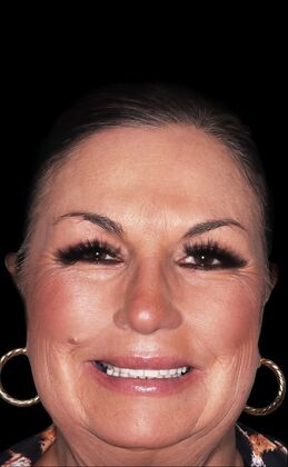 Porcelain Veneers: Gaby- Veneers - After