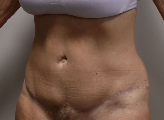 Tummy Tuck (Abdominoplasty): Case 384 - After